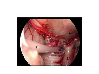 The AcomA complex is usually above the optic chiasm (70 % of cases)
(Rhoton 2003 ) . The AcomA is similar to the textbook description in three-
fourths of cases. In about 10 % of cases, it can be hypoplastic or even
duplicated and triplicated (Lang 1995 ) .
• 1. Supra-chiasmatic
cistern
• 2. Chiasmatic cistern
• 3. Sub -chiasmatic
cistern
 