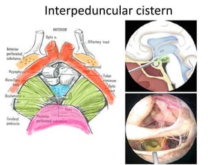 Below the OT & A1 you will see PComA
Endoscopic view of the anterior part of the Left Suprasellar area [ = Sub-
Chiasmatic Cisttern ] . A1 first segment of the anterior cerebral artery, AChA
anterior choroidal artery, GR gyrus rectus, ICA internal carotid artery, OC optic chiasm,
ON optic nerve, OT optic tract, PCoA posterior communicating artery, PG pituitary
gland, PitS pituitary stalk, MB midbrain, U uncus
 