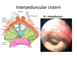 Chiasmatic cistern –
The chiasmatic cistern is located in front of the
optic chiasm and above the sella turcica. In the lateral border of the
chiasmatic cistern the first part of the ICAi is visible.
lt ICA SEEN ON LT SIDE.. A HOLE IN THE ARACHNOID..
THE STALK JUST BEHIND IT.. THE DIAPHRAGM SEEN IN
5/6 O CLOCK POSITION..
 