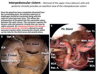 CSF rhinorrhoea case
Closed with hadad flap
lt ICA SEEN ON LT SIDE.. A HOLE IN THE ARACHNOID..
THE STALK JUST BEHIND IT.. THE DIAPHRAGM SEEN IN
5/6 O CLOCK POSITION..
 