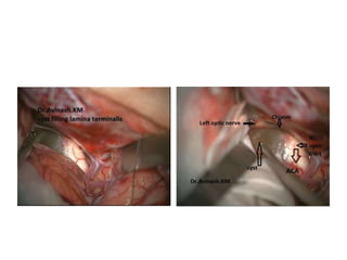 Interpeduncular cistern[ = basal
cistern ]
 
