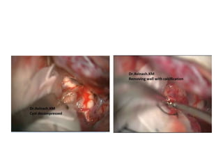 Interpeduncular cistern
 