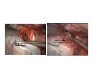 Interpeduncular cistern -- Removal of the upper clivus (dorsum sella and
posterior clinoids) provides an excellent view of the interpeduncular cistern
Once the gland has been completely dissected from
the surrounding dura, the pituitary aperture or
diaphragm should be transected along with the
superior intercavernous sinus. This allows the
transposition of the gland into the suprasellar space,
between the optic nerves. This maneuver exposes the
dorsum sella and posterior clinoids that can now be
safely removed. An osteotomy between the dorsum
sella and the posterior clinoids is advised to avoid
excessive traction while removing the clinoid, which
can be risky for the third nerve and carotid artery.
 