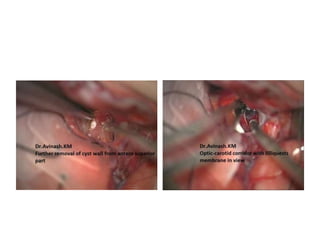 Right supraorbital approach (30 optic).
Window between cn II and ICA: 1 left
PCoA, 2 left P2, 3 left cn III, 4 left P1, 5
left SCA, 6 BA, 7 doubled right SCA, 8
right cn III, 9 right P1, 10 mammillary
bodies, 11 tuber cinereum, 12 right
PCoA, 13 right M1.* sucker
 