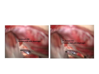 Mammillary bodies
Without removing the DS ,
Subchiasmatic view downwards
After removing the DS &
midclivus
 