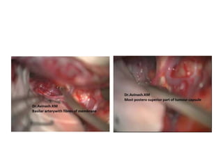 Craniopharyngioma
https://www.facebook.com/groups/4
05175366256295/permalink/552393
251534505/?stream_ref=2
 