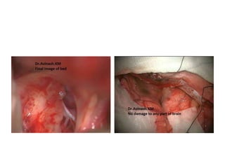 CRANIOPHARYNGIOMAS-Removal corridors.
 