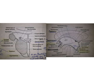 FIGURE 3. Large craniopharyngioma (Patient 3) produced unilateral hydrocephalus
by obstructing the right formen of Monro A. The dome was filled with soft
cholesterine cristals B, which were easily removed. Lower limbus of the right foramen
of Monro is seen through the empty third ventricle D. Despite bilateral preservation
of anteromedial hypothalamus C and stalk preservation E, the patient developed
panhypopituitarism and diabetes insipidus with long lasting psychoorganic change
 
