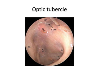 Accessing intraconal lesions endonasally requires manipulation of the extraocular
muscles. The nerve branches that supply the oculomotor muscles run in the medial
surface of the muscles. Thus, try to avoid excessive retraction of the extraocular
muscles to avoid inadvertent muscle paresis.
 