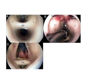 Interpeduncular cistern
3rd ventricle is visualised
..through the tuber cinereum
 