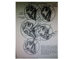 Recurrent artery of Heubner
 