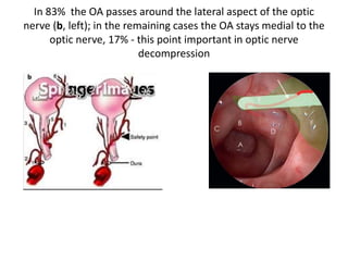 OPTIC NERVE DECOMPRESSION
 