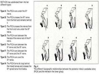 3rd ventricle entry by - Supra optic chiasmic route – by
Lamina terminalis
 