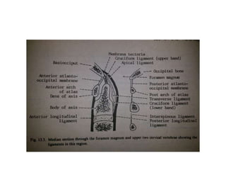 CC corpus callosum, CP choroid plexus, MI massa intermedia, PC posterior commissure, T
thalamus, ThV fl floor of the third ventricle, yellow arrow opening of the Silvius aqueduct, red
asterisk suprapineal recess, white asterisk ( left ) lateral ventricle, white circles foramen of
Monro
 
