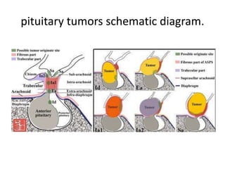 Different positions of the anterior inferior cerebellar artery (AICA) in relation to the
internal auditory meatus.
 