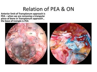 In 83% the OA passes around the lateral aspect of the optic
nerve (b, left); in the remaining cases the OA stays medial to the
optic nerve, 17% - this point important in optic nerve
decompression
 