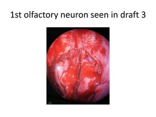 anterolateral endonasal flap.
 