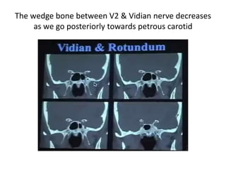 pituitary tumors schematic diagram.
 