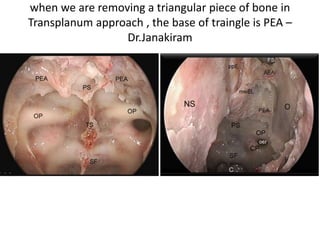 One artery in the head which we can’t move – is
OA – Central retinal artery is avulsed
 
