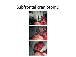 Outside-in approach of draf III –
similar like outside-in mastoid
Inside-out approach of draf III –
similar like Inside-out mastoid
 
