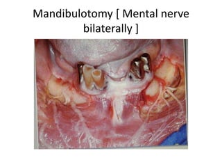 Trans-ptyregoid approach
 