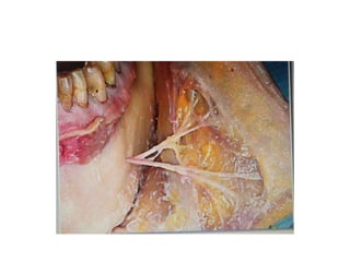 The wedge bone between V2 & Vidian nerve
decreases as we go posteriorly towards petrous
carotid
 