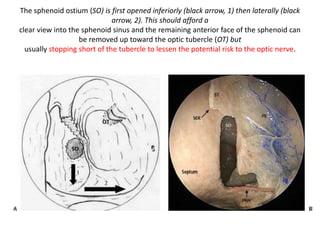 Relation of PEA & ON
Anterior limit of Transplanum approach is
PEA – when we are removing a triangular
piece of bone in Transplanum approach ,
the base of traingle is PEA
 