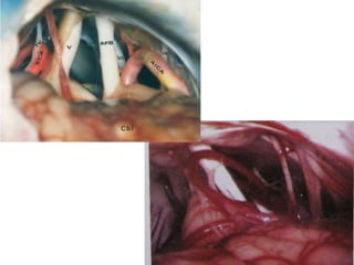 anterior ethmoidal artery ( AEA) and nerve
(AEN) , anterior falcine artery (AFA)
 