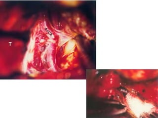 Deep temporal artery
 