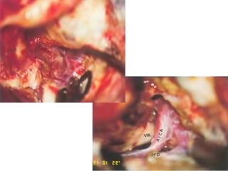 Trigeminal area at Cerebello Pontine
Angle – along with my voice
Click
http://www.youtube
.com/watch?v=YBqk
4Jdnxic
 