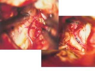 Frontal sinus surgery concepts – must for to do DRAF-III
– Don’t use cutting burr while drilling the Frontal-T ,
high chances of injuring the dura -- use only dimond
drill
Click
http://www.youtube.com
/watch?v=2rhafq3Ur0s
 
