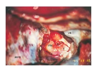 Subfrontal craniotomy.
 