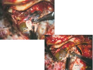Subfrontal craniotomy.
 