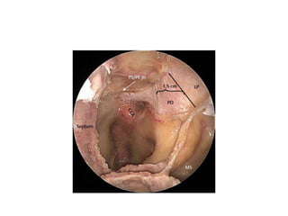 when we are removing a triangular piece of bone in
Transplanum approach , the base of traingle is PEA
 