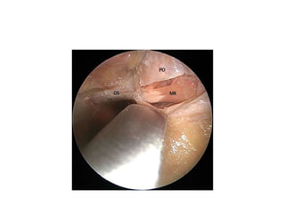The sphenoid ostium (SO) is first opened inferiorly (black arrow, 1) then laterally (black
arrow, 2). This should afford a
clear view into the sphenoid sinus and the remaining anterior face of the sphenoid can
be removed up toward the optic tubercle (OT) but
usually stopping short of the tubercle to lessen the potential risk to the optic nerve.
 
