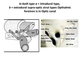 Opthalmic artery – Retrograde branch of Intracranial carotid
Branches of the cavernous internal
carotid artery ( ICA ), a rare
variation: ophthalmic
artery passing through the superior
orbital fissure
 