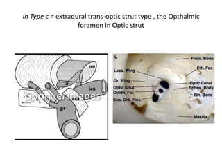 classification of the ophthalmic artery types
http://www.springerimages.com/Images/MedicineAndPublicHealth/1-
10.1007_s10143-006-0028-6-1
a = intradural type,
b = extradural supra-optic strut type [ Optic strut = L-OCR ]
c = extradural trans-optic strut type
on optic nerve, pr proximal ring, cdr carotid dural
ring= upper dural ring , ica internal carotid artery
I think this variation is type c
 