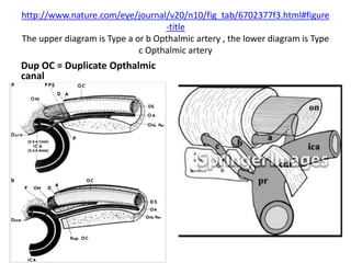 In both type a = intradural type,
b = extradural supra-optic strut types Opthalmic
foramen is in Optic canal
 