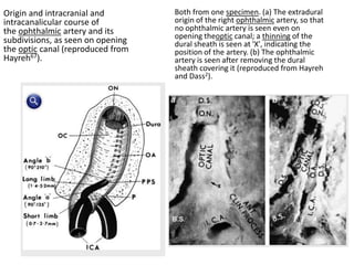 In Type c = extradural trans-optic strut type , the Opthalmic
foramen in Optic strut
 