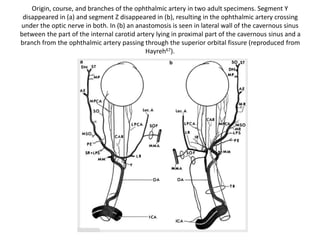 Schematic drawing origin (a medial, b central, c lateral) and exit
(d lateral, emedial) of superior wall of the ophthalmic artery
 