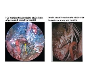 The dura over the ACP passes over the
ON, giving the falciform ligament
 