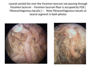 FCB-Fibrocartilago basalis at junction
of petrous & paraclival carotid
Fibrous tissue surrounds the entrance of
the vertebral artery into the CPA.
 