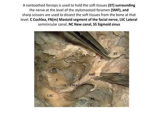 Fibrous tissue surrounds the entrance of
the vertebral artery into the CPA.
Left side. Combined transsigmoid, suboccipital
and extreme lateral approaches provide an
overview off the craniocervical junction, the
foramen magnum area, and the surrounding
structures of the medullary stem.
 