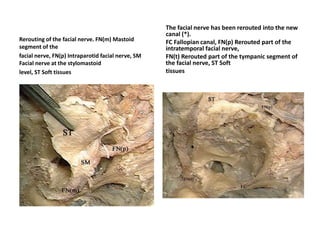 Laceral carotid lies over the Foramen lacerum not passing through
Foramen lacerum - Foramen lacerum floor is occupied by FCB [
Fibrocartilagenous basalis ] -- Note Fibrocartilagenous basalis at
laceral segment in both photos
 