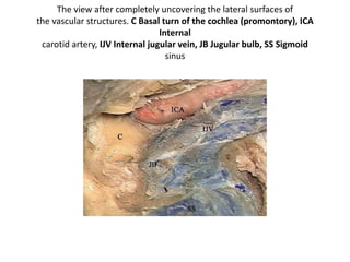 After the attached muscles have been dissected away, the
styloid process (SP) is fractured using a rongeur. FC Fallopian canal,
FN Facial nerve, FN(p) Rerouted part of the intraparotid facial nerve,
TB Temporal bone
 