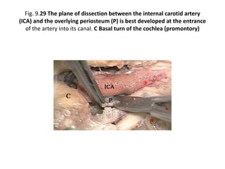 Fig. 9.21 To obtain control over the vascular structures as they enter
the temporal bone, the tympanic bone (TB), the fallopian canal remnants
(FC), and the infralabyrinthine air cells are all to be removed.
C Basal turn of the cochlea (promontory), IJV Internal jugular vein,
JB Jugular bulb, SS Sigmoid sinus
 