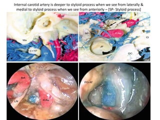 The view after completely uncovering the lateral surfaces of
the vascular structures. C Basal turn of the cochlea (promontory), ICA
Internal
carotid artery, IJV Internal jugular vein, JB Jugular bulb, SS Sigmoid
sinus
 