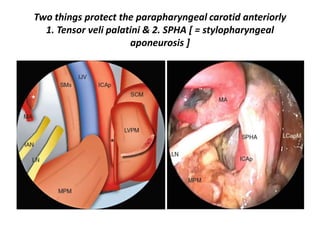 Fig. 9.29 The plane of dissection between the internal carotid artery
(ICA) and the overlying periosteum (P) is best developed at the entrance
of the artery into its canal. C Basal turn of the cochlea (promontory)
 