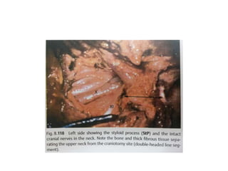 Internal carotid artery is deeper to styloid process when we see from laterally &
medial to styloid process when we see from anteriorly – [SP- Styloid process]
 