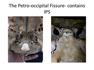 HVP hypoglossal
venous plexus
 